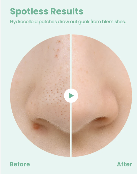 GLAM UP Spotless Nose Hydrocolloid Patch (12 patches)